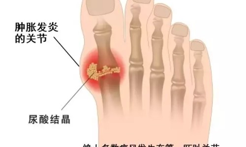 心衰病人可以透析嘛网心衰病人一般能活多久知识网站,分享心衰病人不能吃的食物大全
